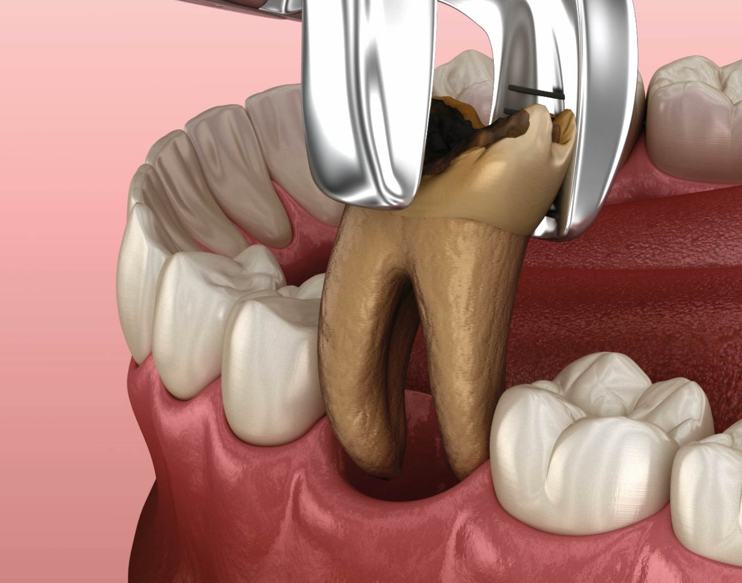 broken wisdom tooth extraction cost